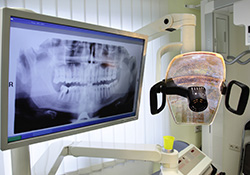 Digital x-rays on computer screen in dental exam room